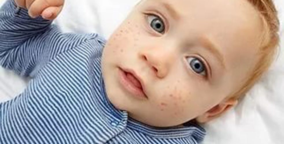 Аллергический дерматит у детей. Аллергическая сыпь у ребенка.
